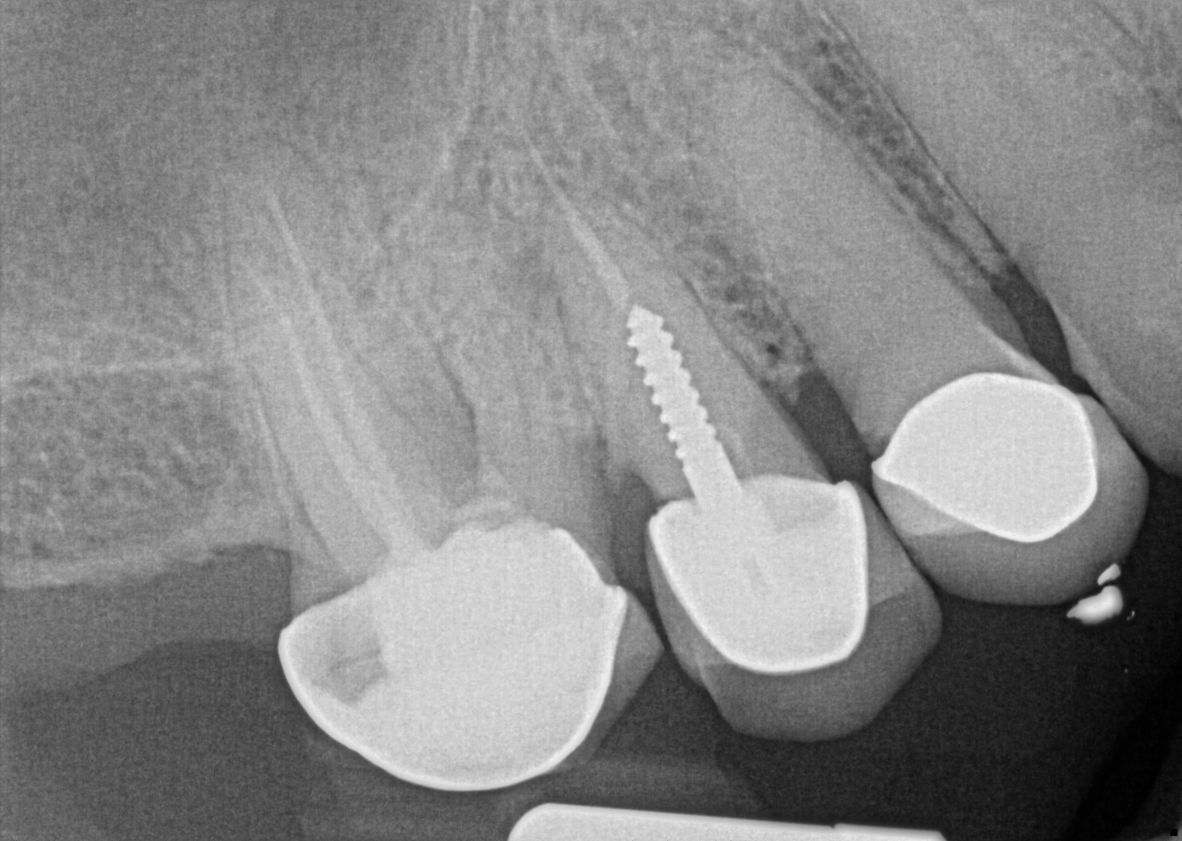 Pre-Operative Radiograph