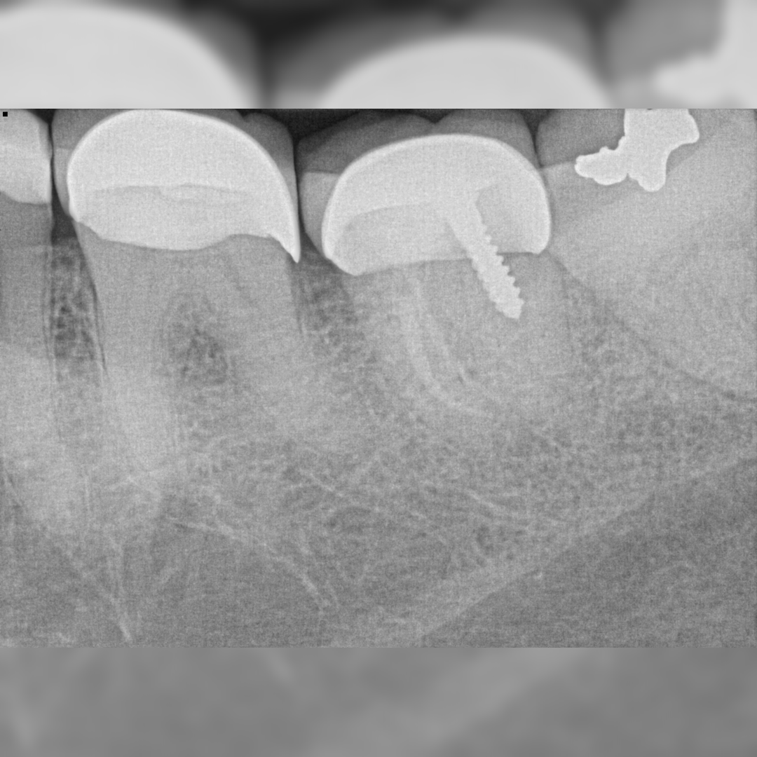 Molar Retreatment - Pre-Operative