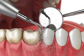 Teeth Cleaning