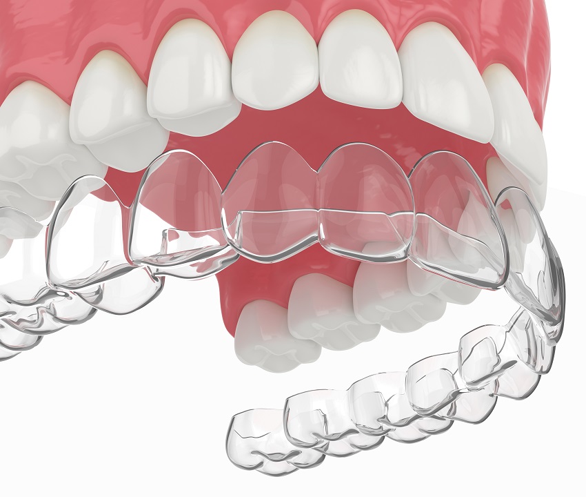 Clear Aligners