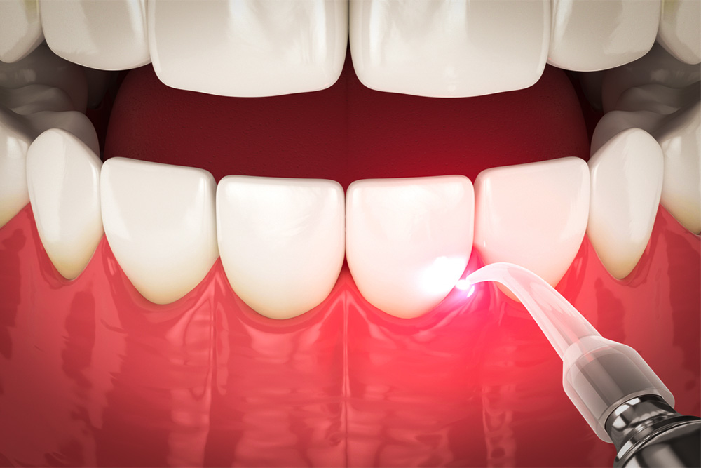 Gum Disease Treatment