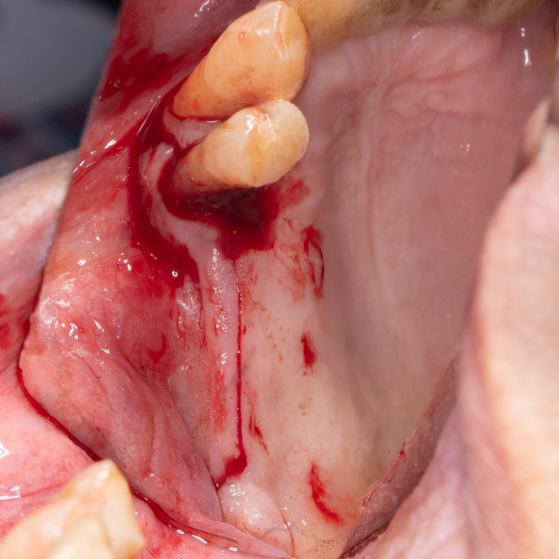 Incision